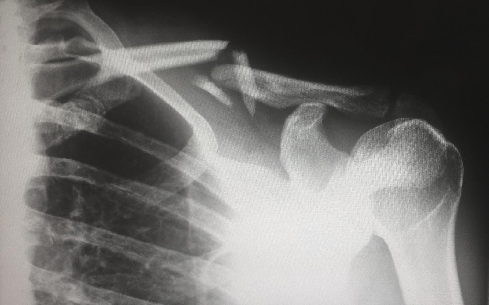 Shoulder X-ray