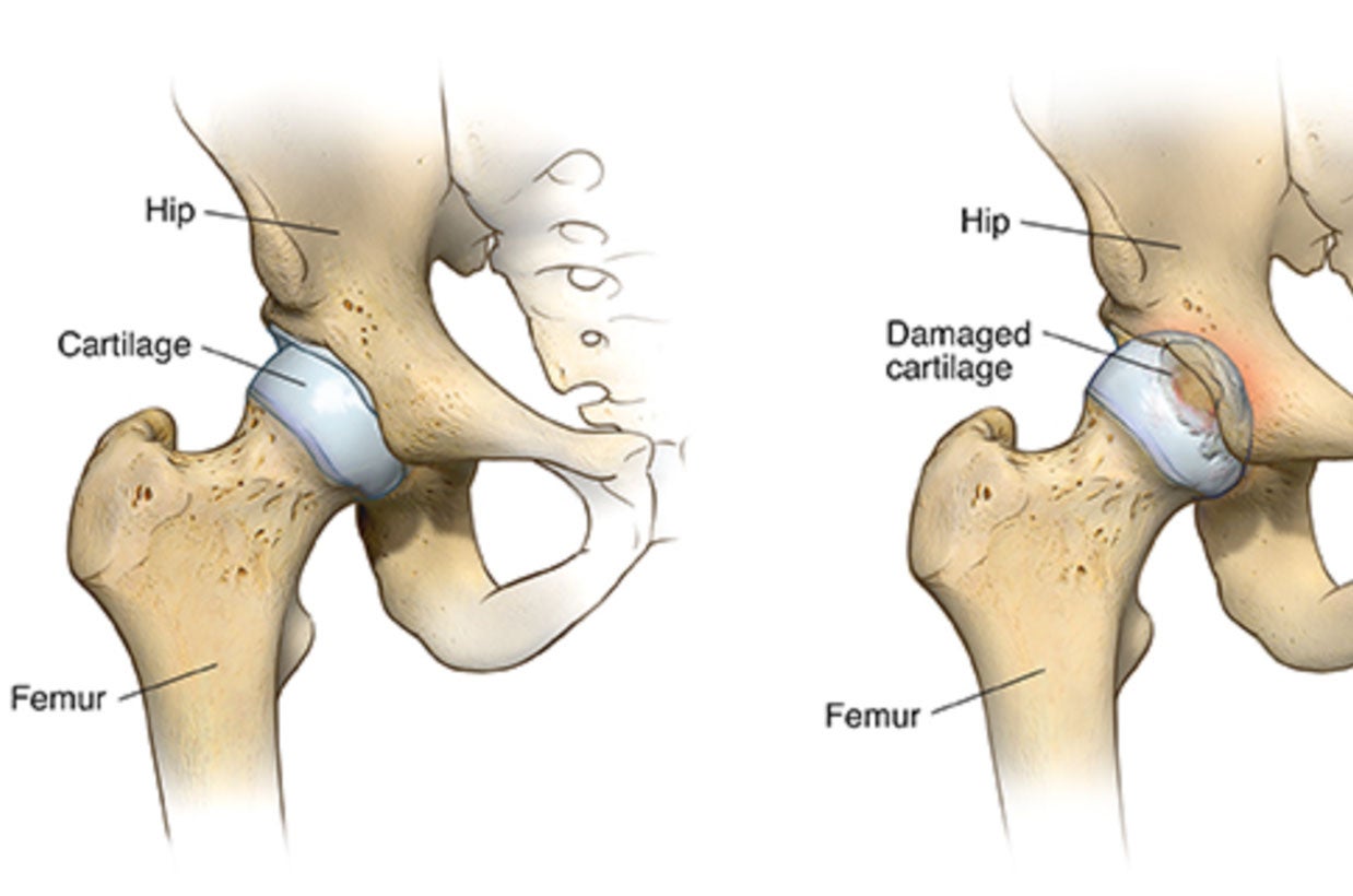 Hip Replacement Surgery