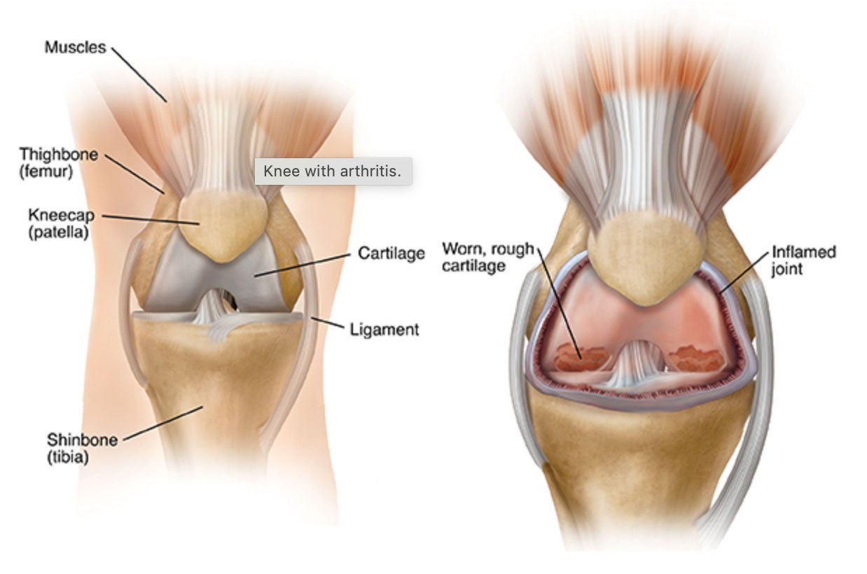 Knee replacement illustration