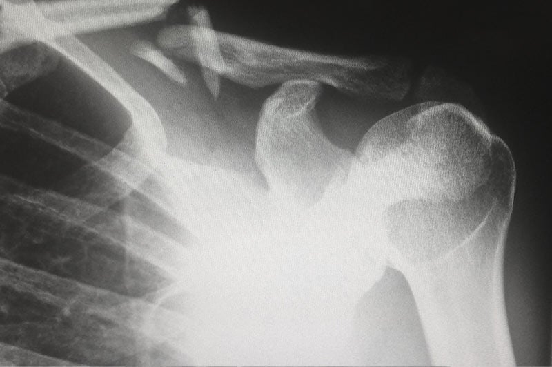 Scan of injured shoulder